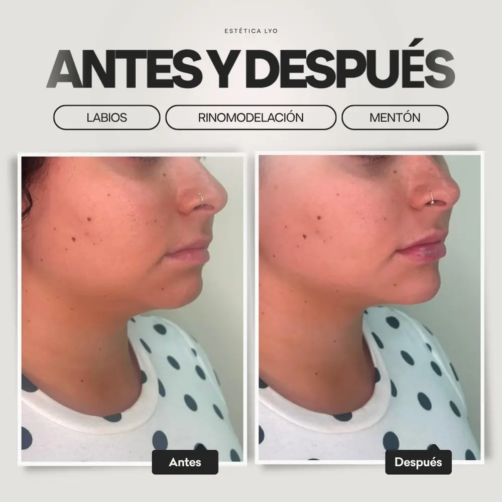 Antes y después: Mentón
